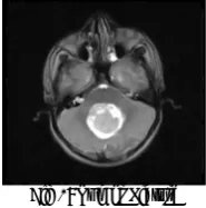 Fig 2: Tumor Picture 