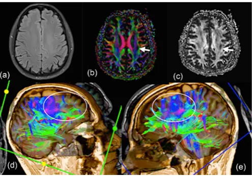 Figure 2. In cases with traumatic brain injury (TBI). (a) At high resolution axial FLAIR image, in coloured (b) and gray scale (c) FA maps; at the levels of axonal discontinuity where FA values decreased as darkened focus (arrows) seen objectively