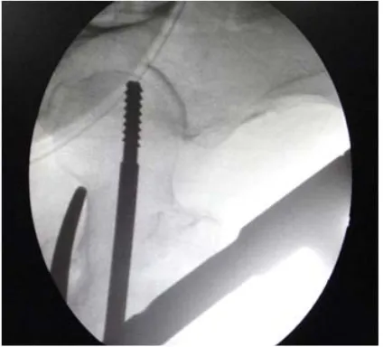 Figure 6. (a) and (b) Shows fracture displacement as nail passes through proximal femur