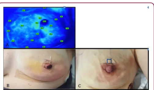 Figure 4 : A. SPY revealed that breast was well perfused at 37 seconds however perfusion was limited in nipple areolar complex (absolute values 2-10)