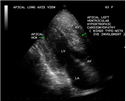 Figure 11. Showing the apical hypertrophic cardiomyopa-chamber view. Arrow mark indicates the lateral wall hyp- thy in a 65-year-old hypertensive female in apical four ertrophy of LV (left ventricular) apex