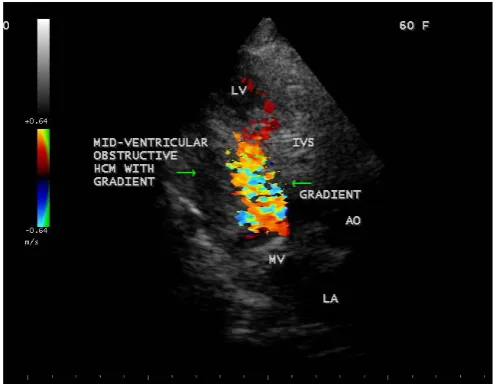 Figure 17. Arrow shows “Isolated basal hypertrophy” of interven-sive male in Parasternal long axis view)