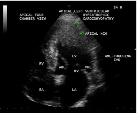 Figure 3. Showing apical HCM in end diastole-mitral valve fully opened position. Arrow mark indicates apical hypertro-phy