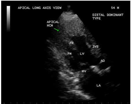 Figure 9. Showing the Apical HCM in short axis view. The ratio of apical thickness to posterior wall thickness is 3.7:1, suggesting apical HCM (hypertrophic cardiomyopathy, i.e., the ratio is > 1.5:1)