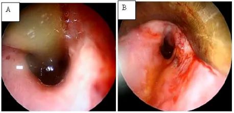 Figure 3. canalised hypopharyngo-oesophageal lumen in case 1 be- fore (image A) and after (image B) removal of the Ryle’s tube which had been in situ for six months