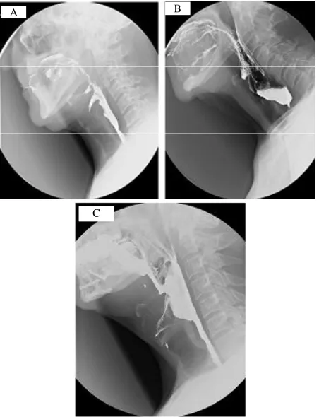 Figure 5. Rigid pharyngoscope images in Case 3 before balloon dilatation (A) and during dilation of twin radio- logical balloon catheters (B)