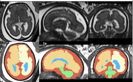 Figure 1.  Axial image (1a) and reconstructed coronal and sagittal images as displayed by the 3D Slicer software