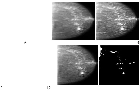 Figure (3) extracting candidate areas from mammograms. A: original image B: improved image 