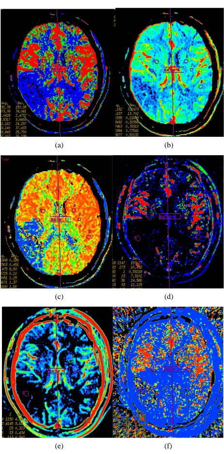 Figure 1. Cerebral Infarction in left basal ganglion. (a) is usual CTP source image, and (b) is SCTP source image