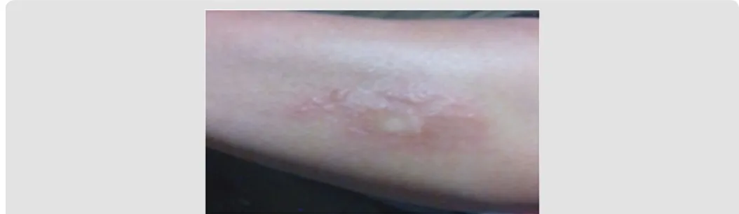 Figure 3: Five minutes after the deposition of the venom, onset of edema, erythema; whitish spot in place of the poison deposit.
