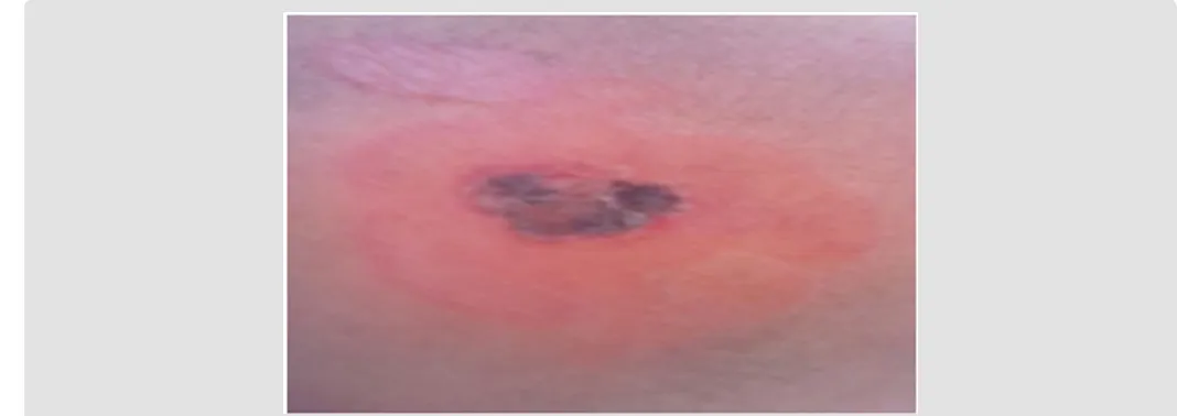 Figure 7: Two weeks after the cantharidin deposit, necrotic tissue is observed in the center and perpetuates the erythema in the peripheral area of the lesion