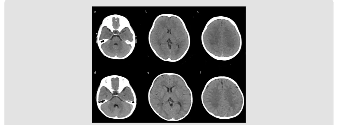 Figure 2: Comparison of representative head CT images of second-generation (a–c), and third-generation CT (d–f) reconstructed using filtered back-projection