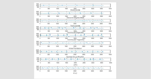 Table 1: The list of the nine classes contained in the testing database and the selected records of the MIT-BIH Database.