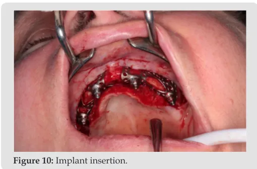 Figure 10: Implant insertion.