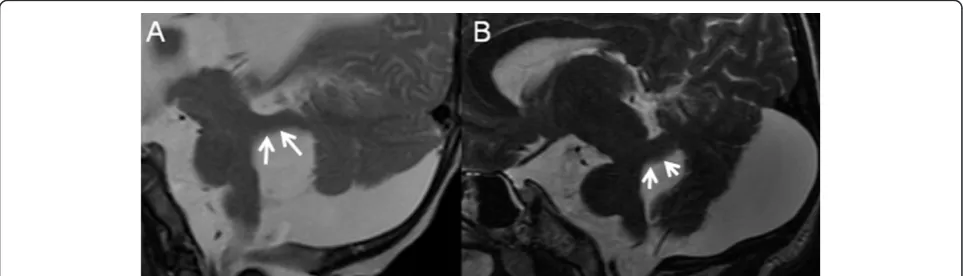Figure 1 Midsagittal T2-weighted MR images of a 22-year-old woman (A) and a 2-day-old neonate (B), modified from Poretti A et al,AJNR, 2008, with permission) with OFD VI reveal an enlarged posterior fossa with marked retrocerebellar CSF collection