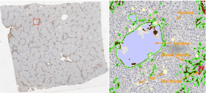 Figure 4 Liver microscopy image segmentation. (Left): a registered microscopy image of a liverslice (n = 10); (Right): a close-up view of segmentation result within the red box regionoverlaid on the left image