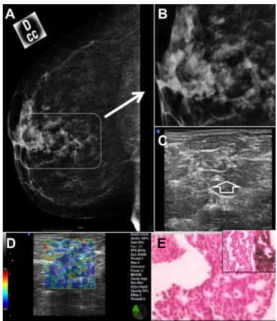 Figure 6 Clustered retroareolar microcalcifications in the right breast of a 52-year-