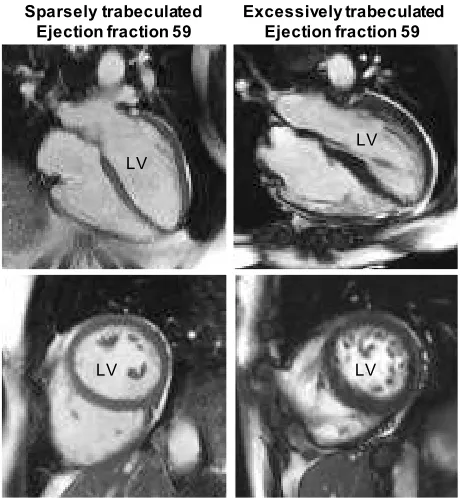 Figure 3. The architecture of the human left ventricle (LV) appears to have no impact on function