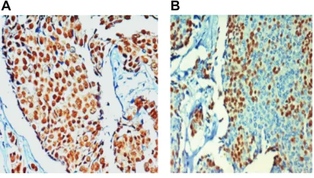 Figure 1 Immunostaining of infiltrating duct breast cancer of Indian women, (×400 objective magnification): dark brown nuclear positive staining for estrogen receptor (A) and dark brown nuclear positive staining for progesterone receptor (B).