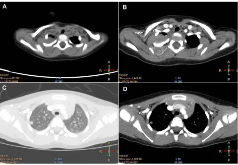 Figure 1 Preoperative image. (A) Axial unenhanced CT scan revealed a large posterior mediastinal mass