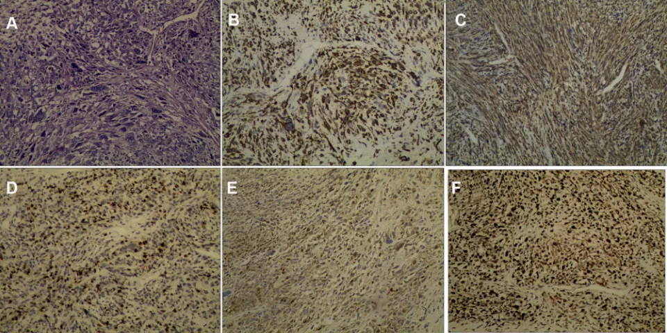 Figure 2 Immunostaining of the resected lesion. (A) Under the microscope, the tissue illustrated a remarkably uniform histological feature (hematoxylin and eosin, ×100).Immunohistochemical staining showed the tumor was strong positive for Desmin (×100) (B)