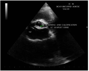 Figure 4. Short axis view showing the bicuspid configuration of the aortic valve.                       