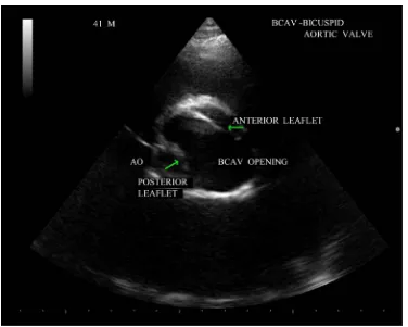 Figure 6. Short axis view showing the “fish mouth” appearance of aortic valve due to thickening and calcification