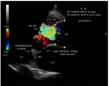 Figure 10. Parasternal long axis view showing the central AR jet in color-doppler imaging—JH/ LOVH (Jet height/left ventricular outflow tract height) ratio—66%—severe AR