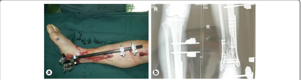 Fig. 1 Open injury of the right lower extremity (a). Tibiofibular comminuted fracture of the right lower extremity (b)