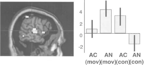 Figure 5. Right middle frontal gyrus (border of BA 8 and 9) activation superimposed ona coronal section of a T1 image