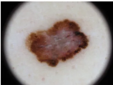 Fig. 4 Dermoscopy picture of a malignant melanoma of the skin. Thecharacteristic blue-white veil has high diagnostic value but requiresprecise color rendering to be identifiable (image courtesy of Dr