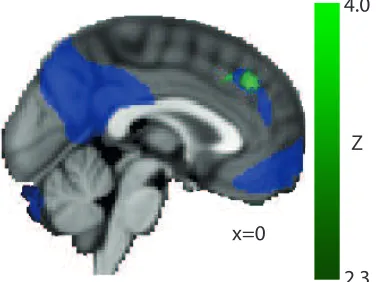 Figure 4: Overlap between the pSPL resting state  network from Figure 2 (purple) and the connectivity between the aSPL region associated with slower Necker cube reversals (green; see Figure 3c)