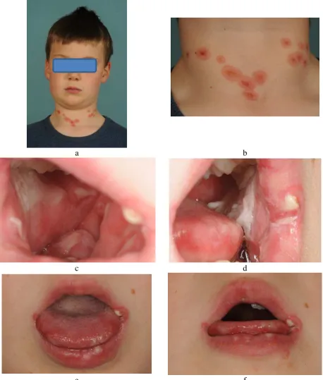 Figure 2: Photographs showing intra- and extra-oral lesions 7 months following initial presentation with (a, b) target lesions on the skin of the neck, (c,d) white plaques with a spongy, corrugated surface affecting the buccal mucosa on both sides, (e,f) grey-yellow ulceration of the 