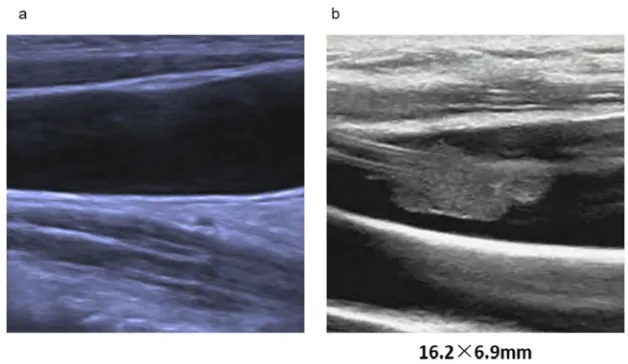 Figure 1 Ultrasound images of right internal jugular veins. (A) Before TIVAD implantation and (B) before TIVAD removal with chemotherapy completed in a breast cancerpatient
