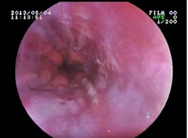 Figure  1  Grade  4  esophagitis  in  SSC  involving 