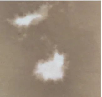 Figure  1  Vitiligo  lesion  showing  marginal  repigmentation  