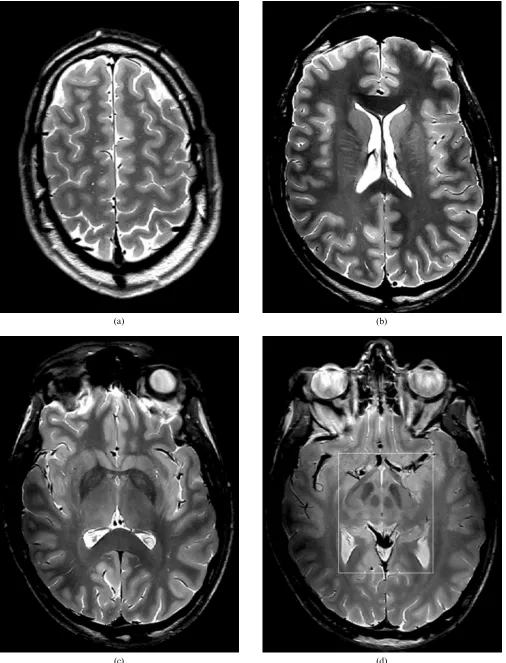 Figure 1. Fast spin echo high resolution transverse MRIs of a healthy volunteer (male, 29 years) displayed with conventional grey scale