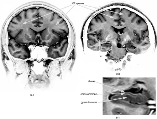 Figure 3. Fast spin echo high resolution coronal MRIs of (a) male, 30 years and (b) and (c) female, 34 years, displayed with aninverted grey scale