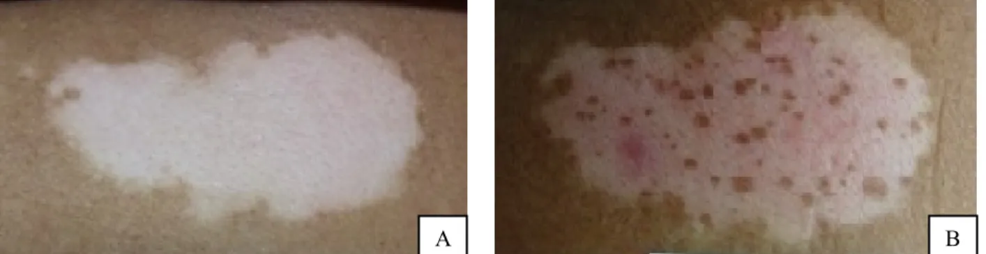 Figure  1  Vitiligo  lesions  before  administration  of  NB-UVB  (A)  and  after  administration  of  NB-UVB  (B)