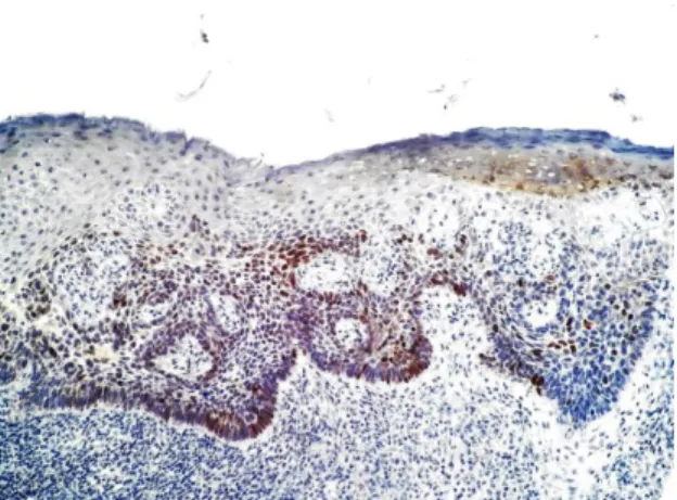 Figure  3  Diffuse  expression  of  AR  (about  70%)  in  nodular-infiltrative  BCC.  Note  decreased  expression  in  tumor  area  (right)  manifesting  an  infiltrative  growth  pattern