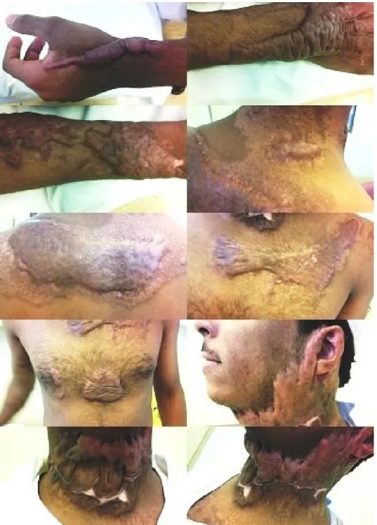 Figure 1 Keloids over multiple areas after nine months of sustaining burn injuries  Individuals  may report experiencing some relief 