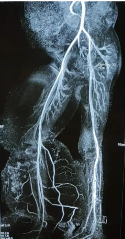 Figure 5 MRA showing normal arterial supply  Figure 6 HPV cytopathic changes  05%,  monocyte  03%,  eosinophil  03%,  low 