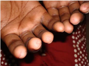 Figure 1 Sclerodactyly in a case of diffuse 