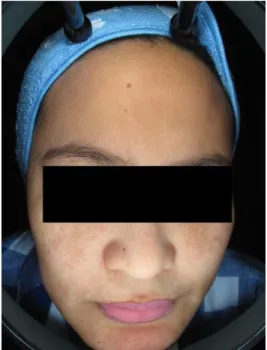 Figure  2  Maxillary  type  of  melasma  (printed  after  permission of subject).