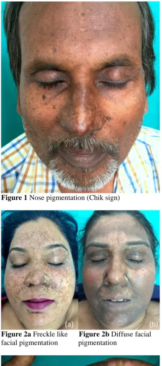 Figure 1 Nose pigmentation (Chik sign) 