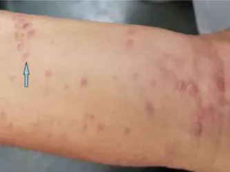 Figure 1 Wickham’s striae and Koebner’s phenomenon.  Figure  2  Hyperkeratosis,  irregular  acanthosis  and 
