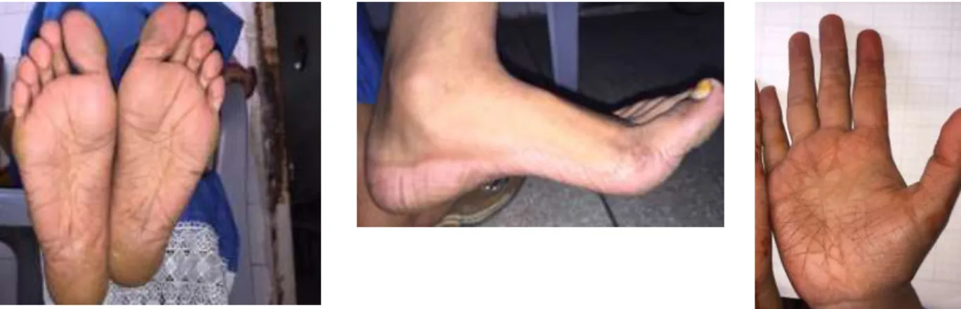 Figure 1  Diffuse palmoplantar keratoderma (Case 1). 