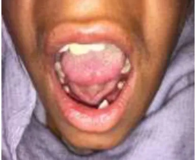 Figure 5  Completely edentulous with a few teeth in the right maxillary quadrant (Case 2)