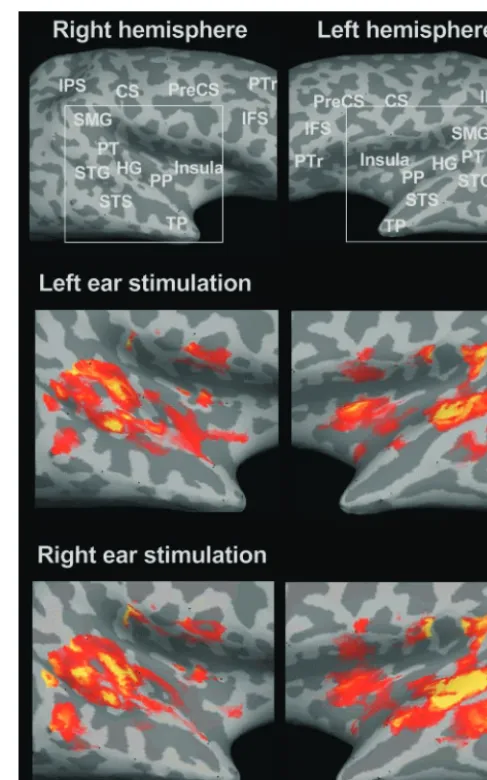 Figure 2.Auditory cortex activations for monaural tones relative to silence for a single par-ticipant