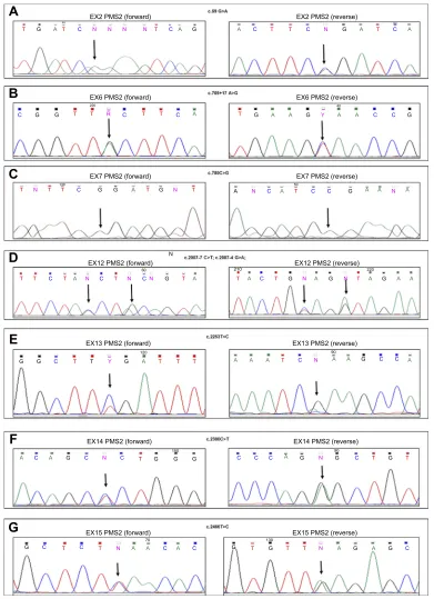 Figure 1 DNA sequencing electropherograms of the PMS2 exon 2 (exon 14 (sample. Arrows indicate the homozygous variant in the exon 7 (A), exon 6 (B), exon 7 (C), exon 12 (D), exon 13 (E), exon 14 (F), and exon 15 (G) for the 07/6 patientC), and the heterozy